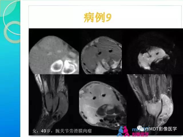 【PPT】滑膜肉瘤的影像诊断