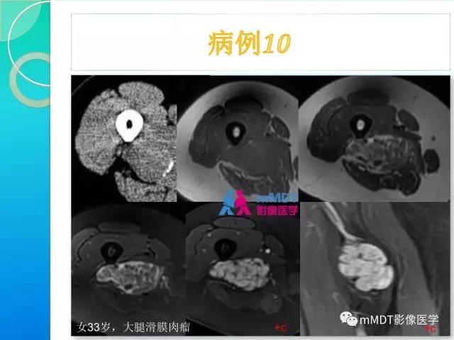 【PPT】滑膜肉瘤的影像诊断