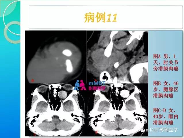【PPT】滑膜肉瘤的影像诊断