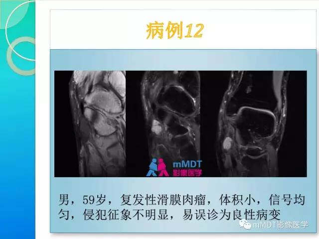 【PPT】滑膜肉瘤的影像诊断