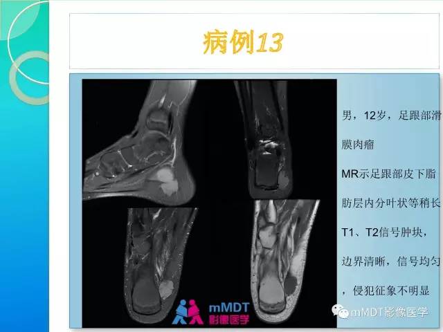 【PPT】滑膜肉瘤的影像诊断