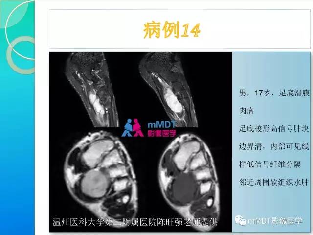 【PPT】滑膜肉瘤的影像诊断