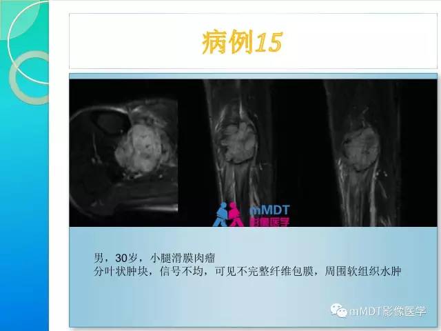 【PPT】滑膜肉瘤的影像诊断