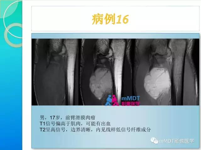 【PPT】滑膜肉瘤的影像诊断