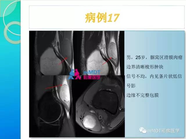 【PPT】滑膜肉瘤的影像诊断