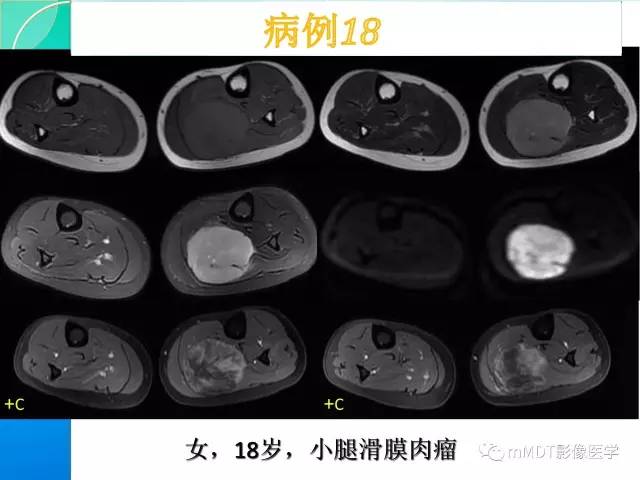 【PPT】滑膜肉瘤的影像诊断