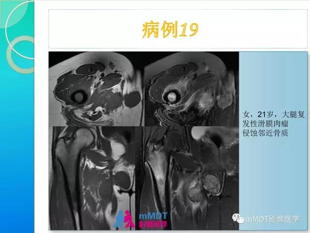 【PPT】滑膜肉瘤的影像诊断
