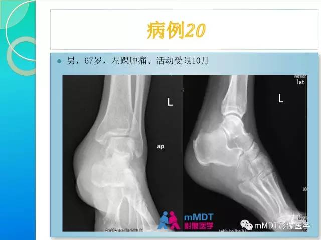 【PPT】滑膜肉瘤的影像诊断