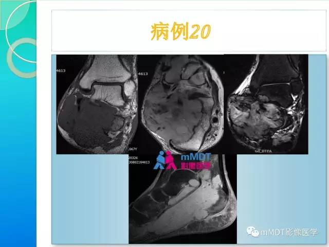 【PPT】滑膜肉瘤的影像诊断