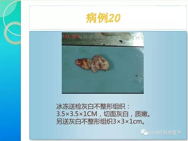 【PPT】滑膜肉瘤的影像诊断
