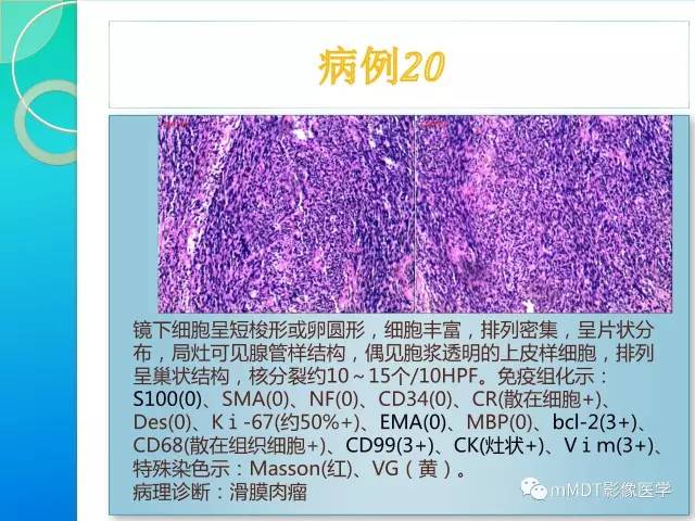 【PPT】滑膜肉瘤的影像诊断