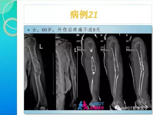 【PPT】滑膜肉瘤的影像诊断