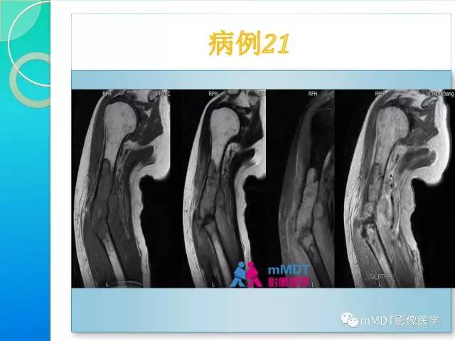 【PPT】滑膜肉瘤的影像诊断