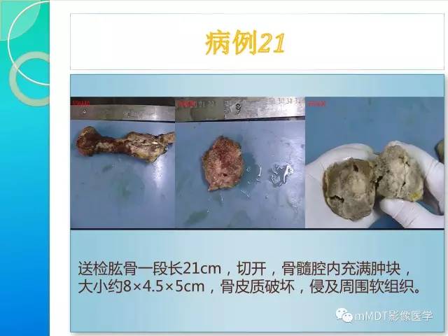 【PPT】滑膜肉瘤的影像诊断