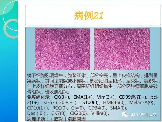 【PPT】滑膜肉瘤的影像诊断