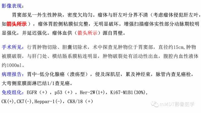 【PPT】外生型胃癌影像表现