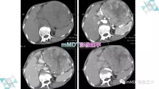 【PPT】外生型胃癌影像表现