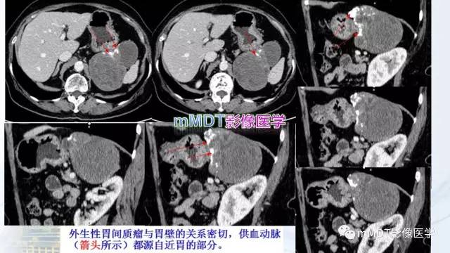 【PPT】外生型胃癌影像表现