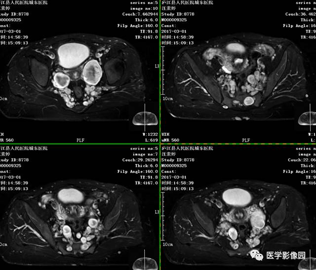 【病例】神经纤维瘤病I型1例MR影像表现