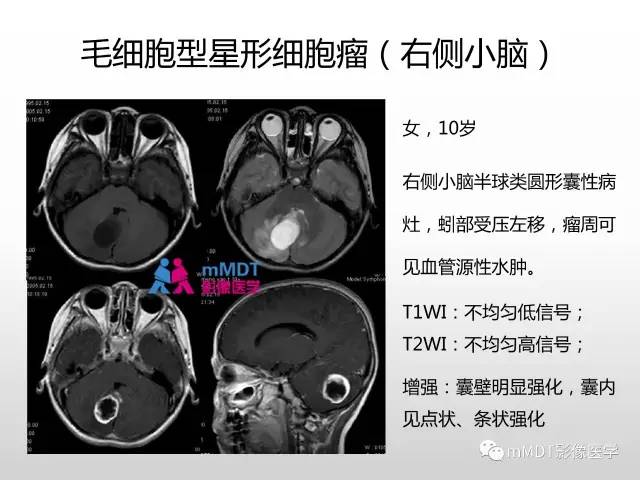 【PPT】浅谈毛细胞型星形细胞瘤影像