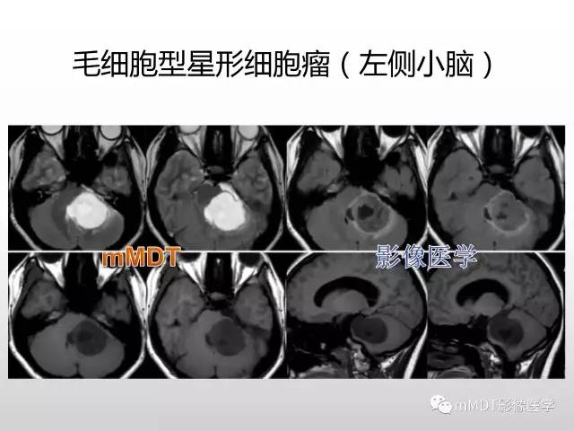 【PPT】浅谈毛细胞型星形细胞瘤影像