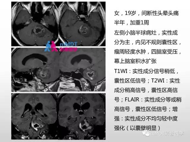 【PPT】浅谈毛细胞型星形细胞瘤影像