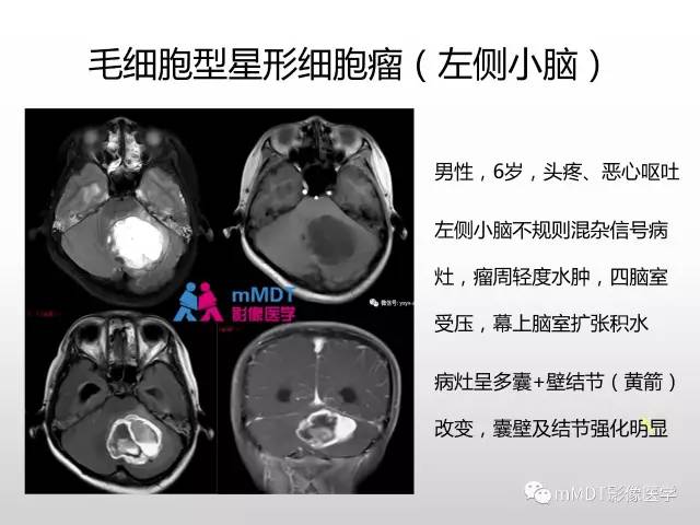 【PPT】浅谈毛细胞型星形细胞瘤影像