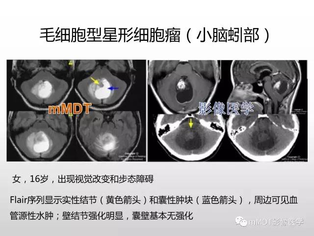 【PPT】浅谈毛细胞型星形细胞瘤影像
