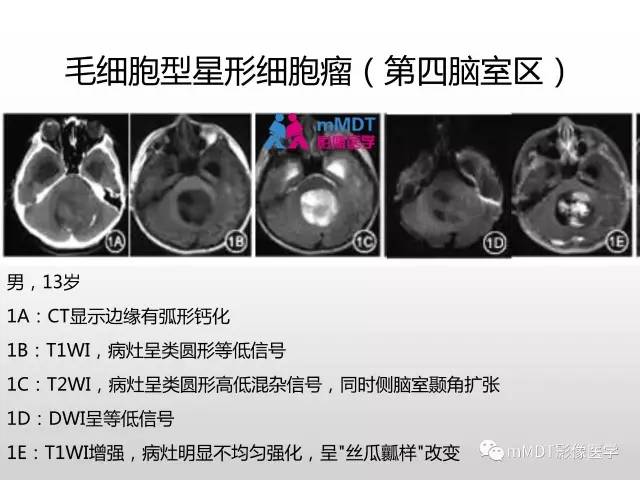 【PPT】浅谈毛细胞型星形细胞瘤影像