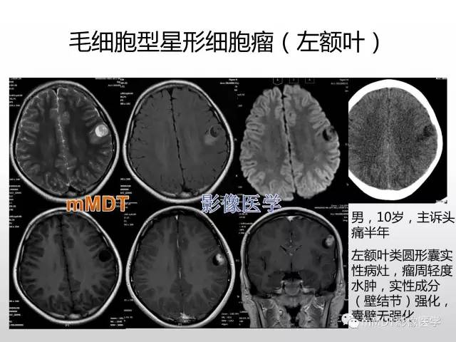 【PPT】浅谈毛细胞型星形细胞瘤影像
