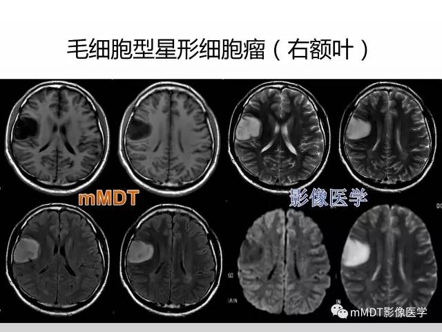 【PPT】浅谈毛细胞型星形细胞瘤影像