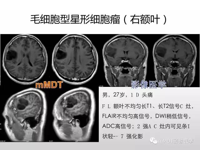 【PPT】浅谈毛细胞型星形细胞瘤影像