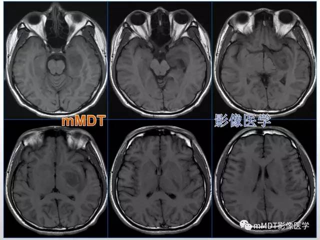 【PPT】浅谈毛细胞型星形细胞瘤影像