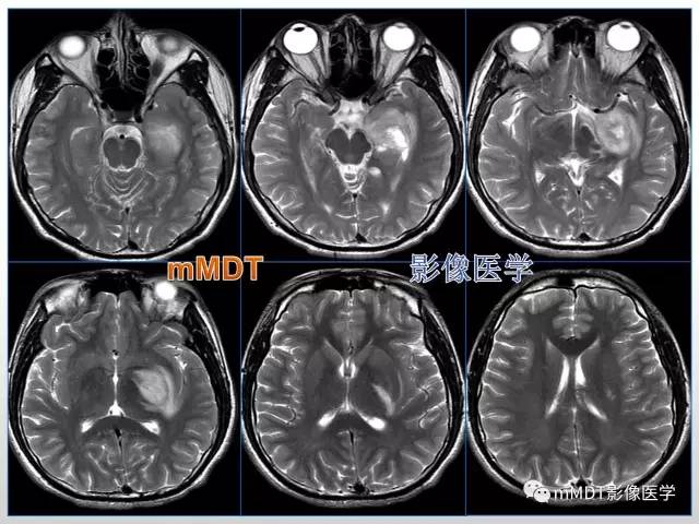 【PPT】浅谈毛细胞型星形细胞瘤影像