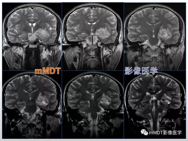 【PPT】浅谈毛细胞型星形细胞瘤影像