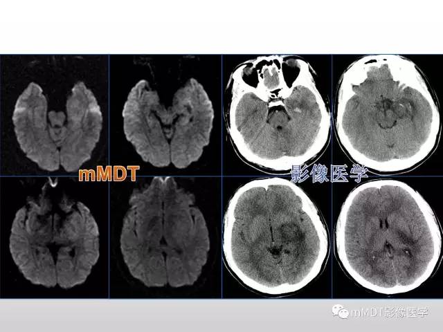 【PPT】浅谈毛细胞型星形细胞瘤影像