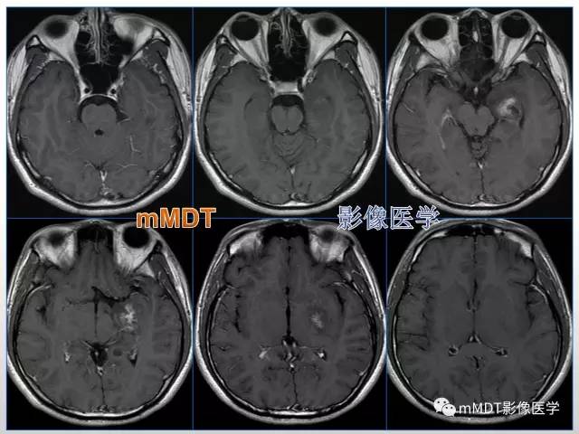 【PPT】浅谈毛细胞型星形细胞瘤影像