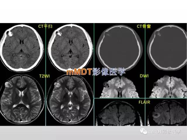 【PPT】浅谈毛细胞型星形细胞瘤影像