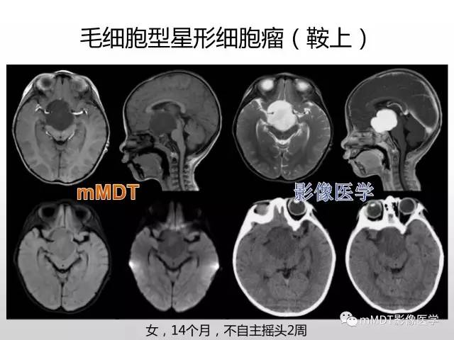 【PPT】浅谈毛细胞型星形细胞瘤影像