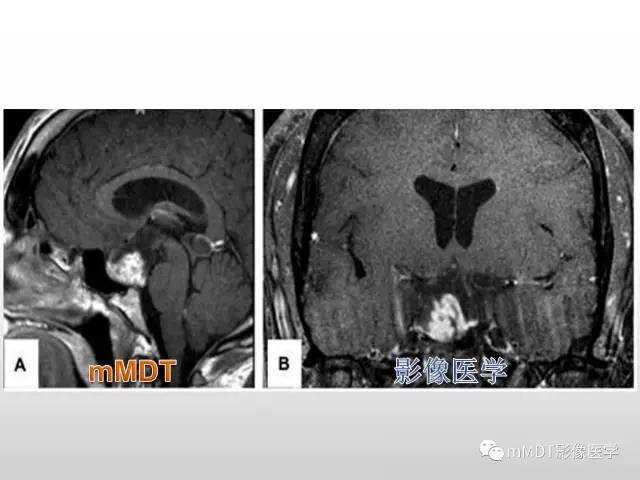 【PPT】浅谈毛细胞型星形细胞瘤影像
