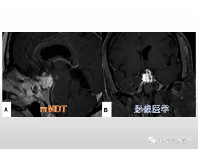 【PPT】浅谈毛细胞型星形细胞瘤影像