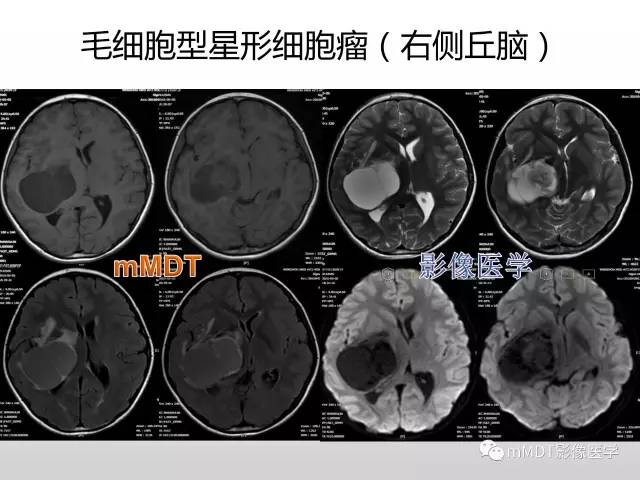 【PPT】浅谈毛细胞型星形细胞瘤影像