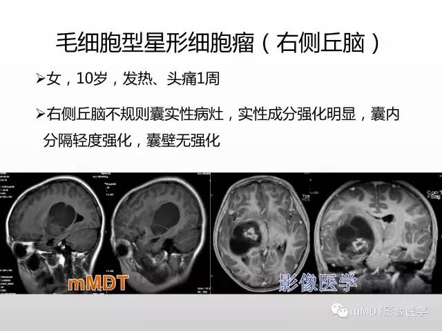 【PPT】浅谈毛细胞型星形细胞瘤影像