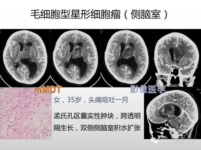【PPT】浅谈毛细胞型星形细胞瘤影像