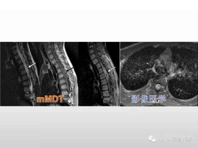 【PPT】浅谈毛细胞型星形细胞瘤影像