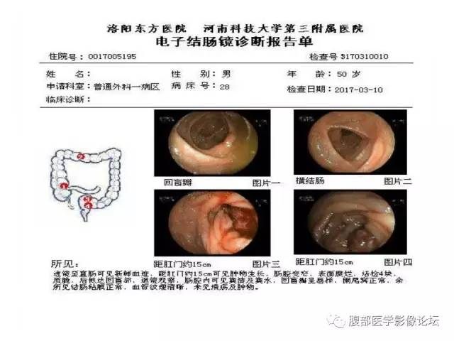 【病例】直肠乙状结肠交界处神经内分泌肿瘤1例CT
