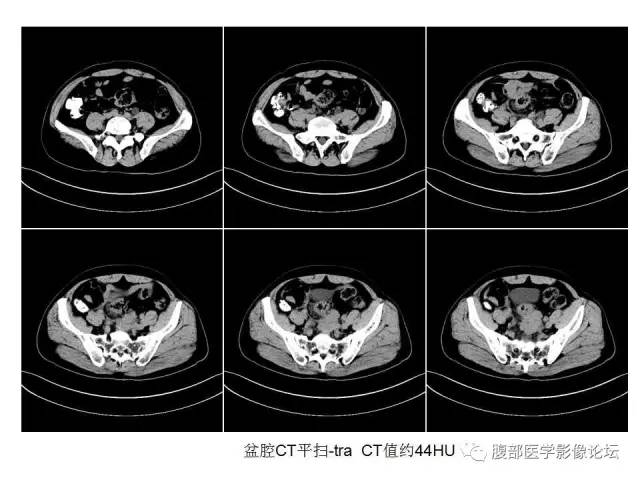 【病例】直肠乙状结肠交界处神经内分泌肿瘤1例CT