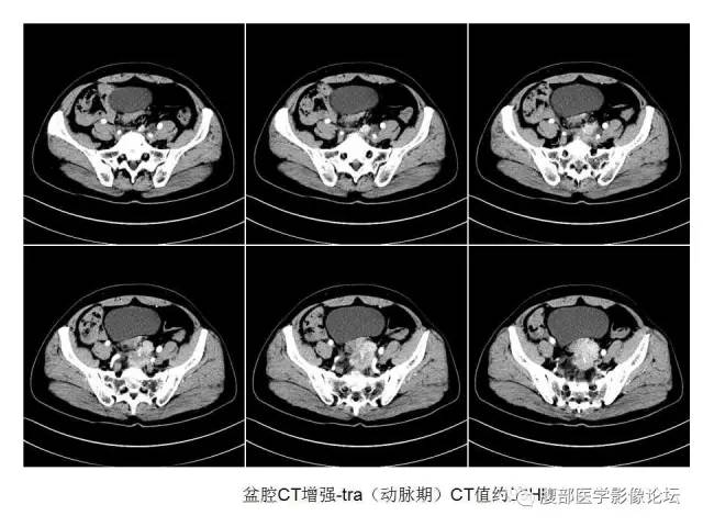 【病例】直肠乙状结肠交界处神经内分泌肿瘤1例CT