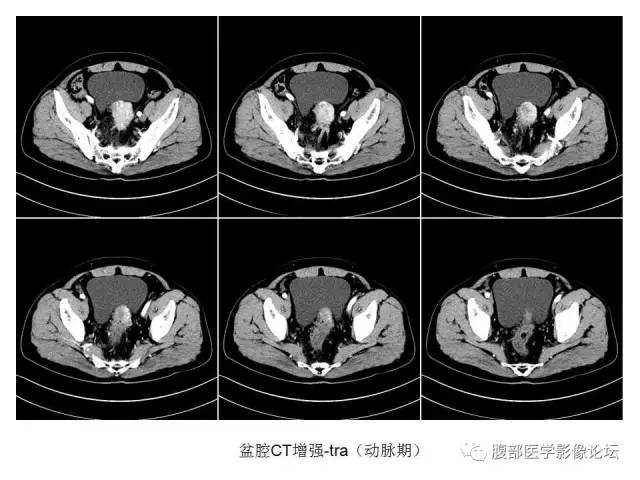 【病例】直肠乙状结肠交界处神经内分泌肿瘤1例CT