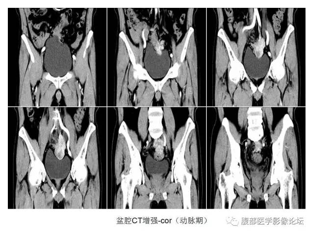 【病例】直肠乙状结肠交界处神经内分泌肿瘤1例CT